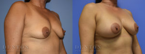 Breast Augmentation B&A 12B