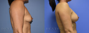 Breast Augmentation B&A 12C