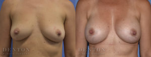 Breast Augmentation B&A 2A