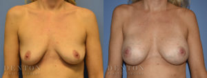 Breast Augmentation B&A 3A