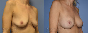 Breast Augmentation B&A 3B