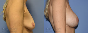 Breast Augmentation B&A 3C