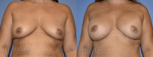 Breast Augmentation B&A 4A