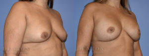 Breast Augmentation B&A 4B