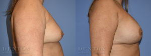 Breast Augmentation B&A 4C