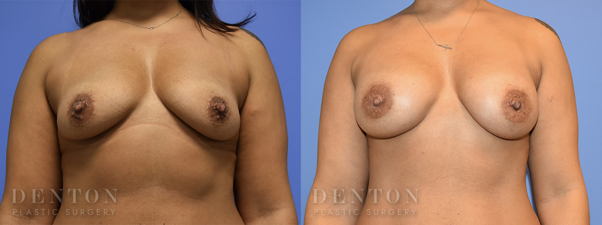 Breast Augmentation B&A 5A