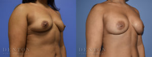 Breast Augmentation B&A 5B