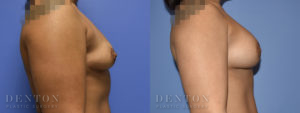 Breast Augmentation B&A 5C