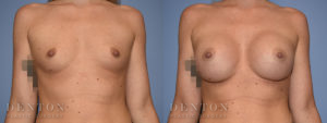Patient 6-A: Breast Augmentation Before & After