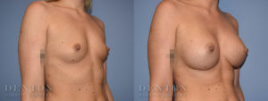 Breast Augmentation B&A 6B