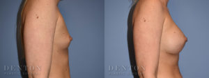 Breast Augmentation B&A 6C