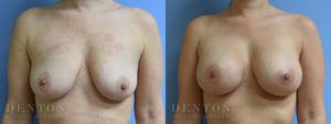 Breast Augmentation B&A 7A