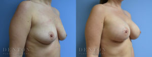 Breast Augmentation B&A 7B