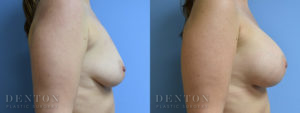 Breast Augmentation B&A 7C