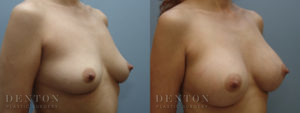 Breast Augmentation B&A 8B