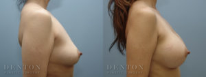 Breast Augmentation B&A 8C