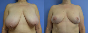 Breast Lift B&A 1A