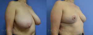 Breast Lift B&A 1B