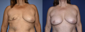 Breast Reconstruction B&A 1A