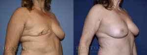 Breast Reconstruction B&A 1B