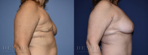 Breast Reconstruction Patient 1-C: Before & After