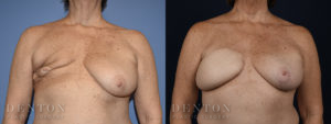 Breast Reconstruction B&A 2A