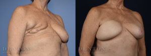 Breast Reconstruction B&A 2B