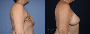 Breast Reconstruction B&A 2C