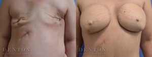 Breast Reconstruction B&A 3A