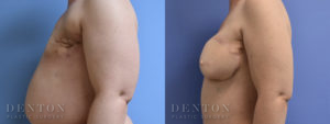 Breast Reconstruction B&A 3C