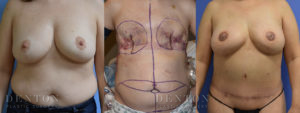 Breast Reconstruction B&A 4A