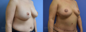 Breast Reconstruction B&A 4B