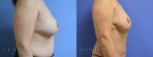 Breast Reconstruction B&A 4C