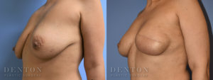 Breast Reconstruction B&A 1B