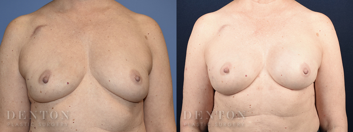 Breast Reconstruction B&A 2A