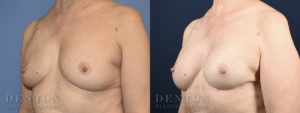 Breast Reconstruction B&A 2B