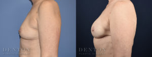 Breast Reconstruction B&A 2C