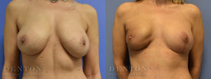 Breast Reconstruction B&A 3A