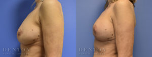 Breast Reconstruction B&A 3C