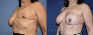 Breast Reconstruction B&A 4B