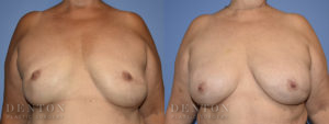 Breast Reconstruction B&A 5A