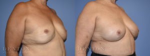 Breast Reconstruction B&A 5B