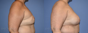 Breast Reconstruction B&A 5C