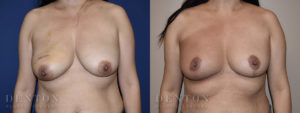 Breast Reconstruction B&A 1A