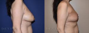 Oncoplastic Reconstruction Patient 1-C: Before & After