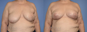 Breast Reconstruction B&A 2A