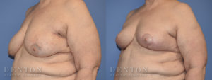 Breast Reconstruction B&A 2B