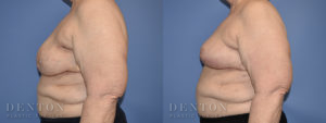 Breast Reconstruction B&A 2C