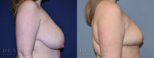 Breast Reduction B&A 3C