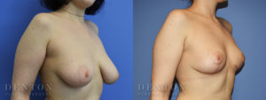 Breast Reduction B&A 4B